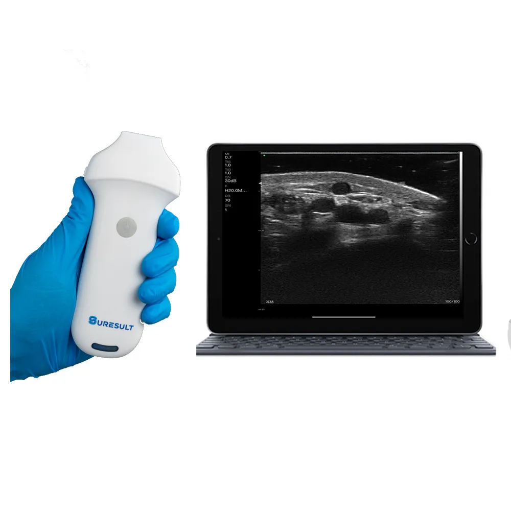 Suresult L10H wireless linear handheld ultrasound